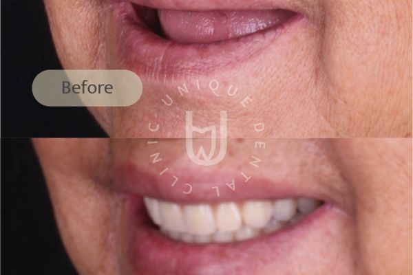 snap-on-dentures